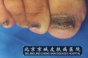 怎么避免甲癣的发生