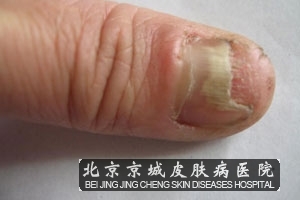 怎样避免甲癣