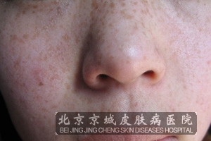 雀斑有什么临床特点