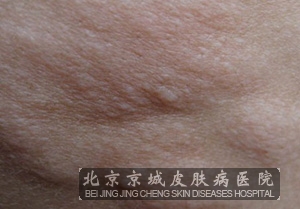 甲周纤维瘤c.多发性脂囊.