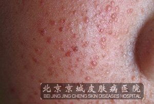 结节硬化症患者一般会有比较明显的症状,主要就是皮肤皮脂腺瘤以及