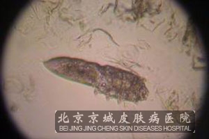 毛囊虫皮炎的发病机理是什么