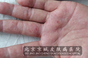 汗疱疹的主要症状是什么