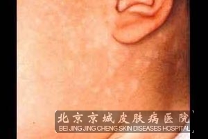随着时间的延长,在皮损部位还可出现色素脱失斑,即白斑,而且白斑也不