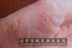 汗疱疹的皮肤特点