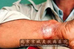 丘疹坏死性结核疹的治疗方法