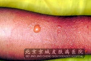 毛虫皮炎的一般发病机制