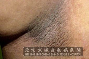 ڼƤ֢ĳ仯