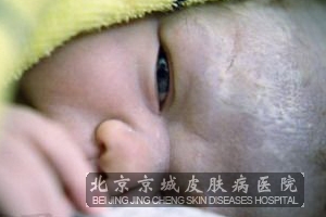 婴儿湿疹的症状怎样分型