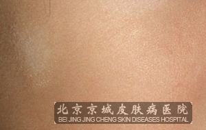 白色糠疹的鉴别方法