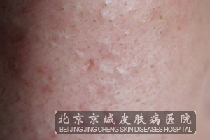 �۴̵�֢״��ʲô