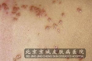 疥疮有什么鉴别诊断