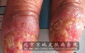 掌跖脓疱病的临床症状是什么