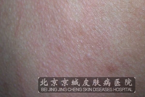 ҩ����Ƥ��Ҫ��ô����