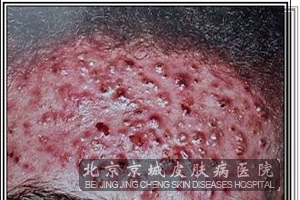 毛囊虫皮炎有哪些症状呢