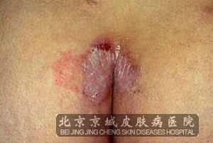 ��������Ƥ�׵�֢״�ص�