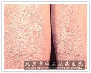 ����Ƥ�׵����ƴ�ʩ��ʲô