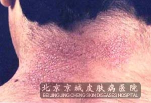 ��������Ƥ�׵��շ�����