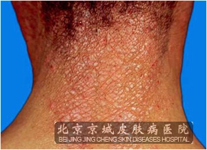 ����Ƥ��Ӧ����������