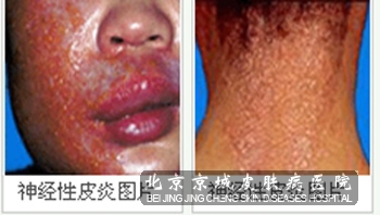 ����Ƥ��Ӧ�����������ź�