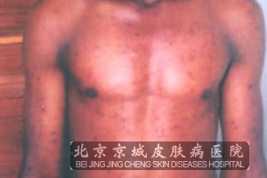 单纯性痒疹的治疗方案是什么