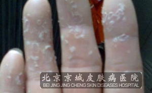 剥脱性角质松解症的处理方案