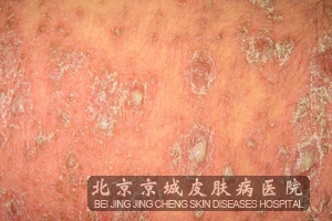 银屑病的鉴别疾病