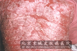 银屑病的症状体征