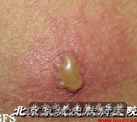 原发性生殖器疱疹要怎样的预防
