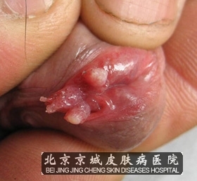 尖锐湿疣反复发作为什么