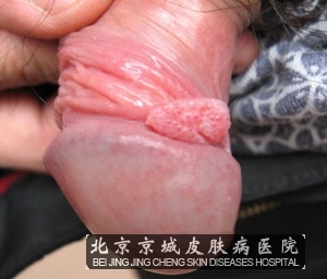 男性尖锐湿疣的症状有哪些