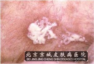 念珠菌病的发生属于正常消化道,有时也是皮肤的常见的共栖性真菌.