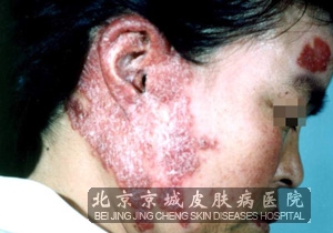 通常情况下患者发生这种病,结核杆菌听歌皮肤损害而发生感染