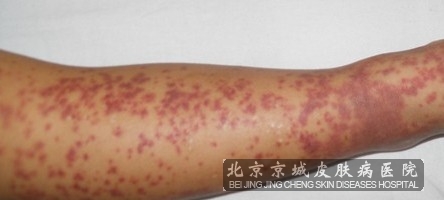 一般认为该病与链球菌感染和药物反应有关.