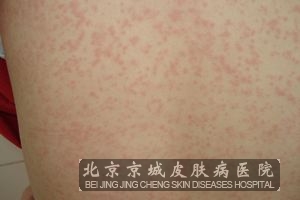 荨麻疹的诊断要迅速