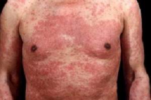 药疹的危害性有多大