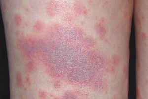 如何应对常见药疹