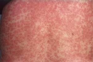 药疹的诊断方法