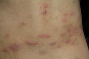 小儿丘疹性荨麻疹不宜吃什么食物