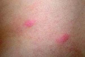 丘疹性荨麻疹会不会传染