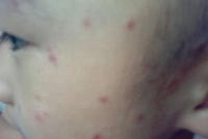 小儿丘疹性荨麻疹的注意事项有哪些