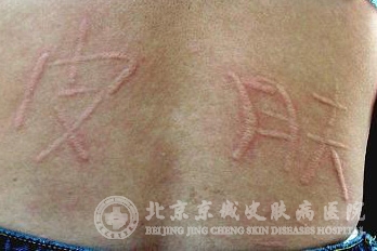 人工性荨麻疹的注意事项