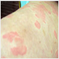 慢性荨麻疹的症状