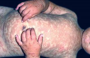 荨麻疹的发病机理是什么