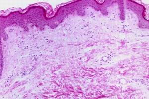 寒冷性荨麻疹预防的必要因素