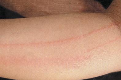 划痕性荨麻疹不治疗可以吗