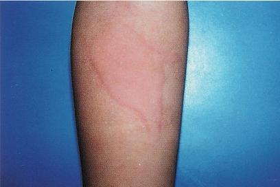 荨麻疹会反复发作吗