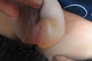 血管性水肿好治吗