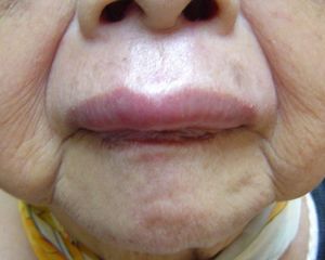 遗传性血管性水肿