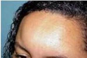 面部血管性水肿会不会致人死亡